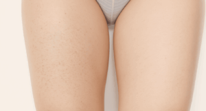 comprendre la cellulite avant d’agir